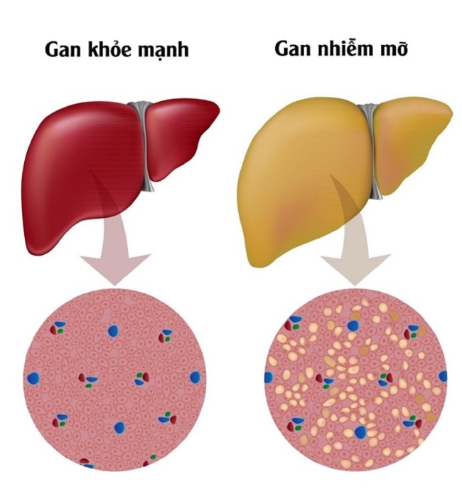 Béo phì là một yếu tố dây tăng tổn thương gan