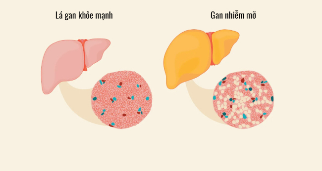 Giai đoạn mỡ tích tụ nhiều trong gan