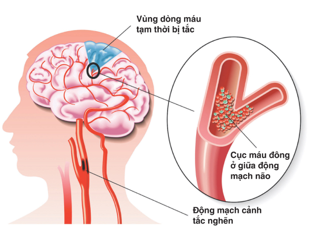 Tắc nghẽn mạch máu não