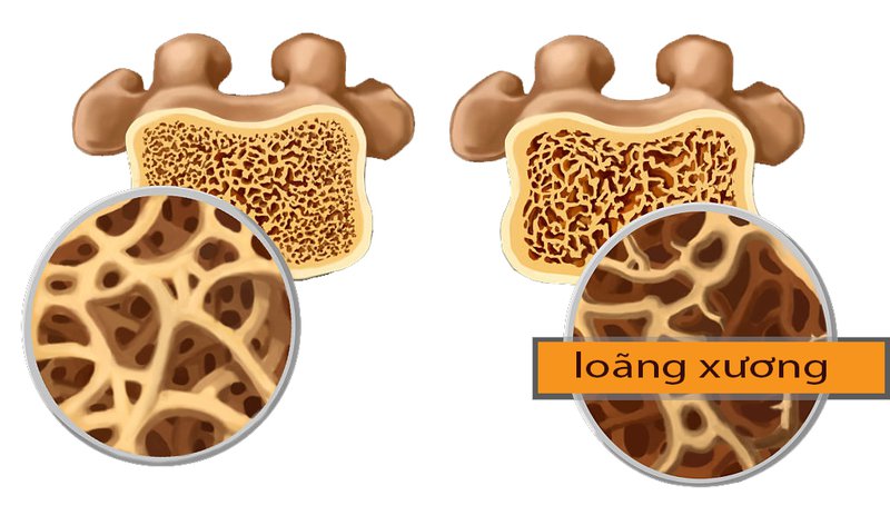 Image result for loÃ£ng xÆ°Æ¡ng