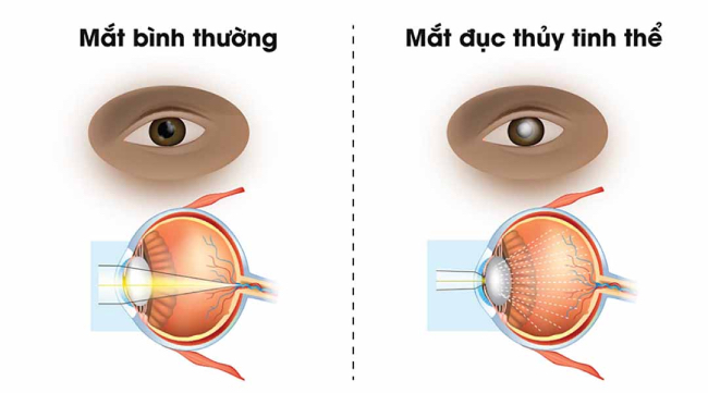 Biến chứng đục thủy tinh thể