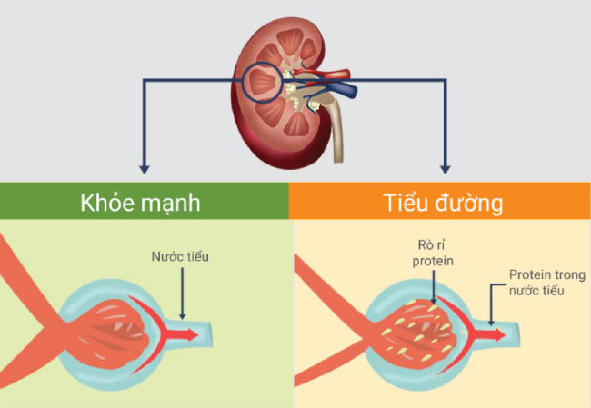 Biến chứng thận tiểu đường
