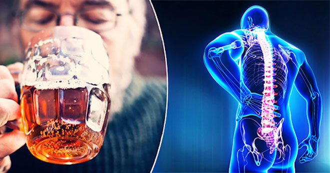Rượu bia là nguyên nhân gây loãng xương