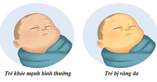 Vàng da ở trẻ sơ sinh 