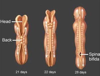 392 Bảo Vệ Trẻ Khỏi Nguy Cơ Dị Tật Ống Thần Kinh