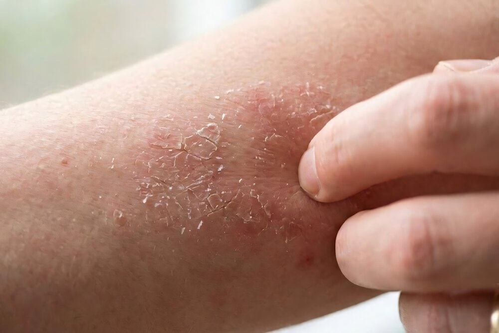 triệu chứng bệnh tiểu đường giai đoạn đầu