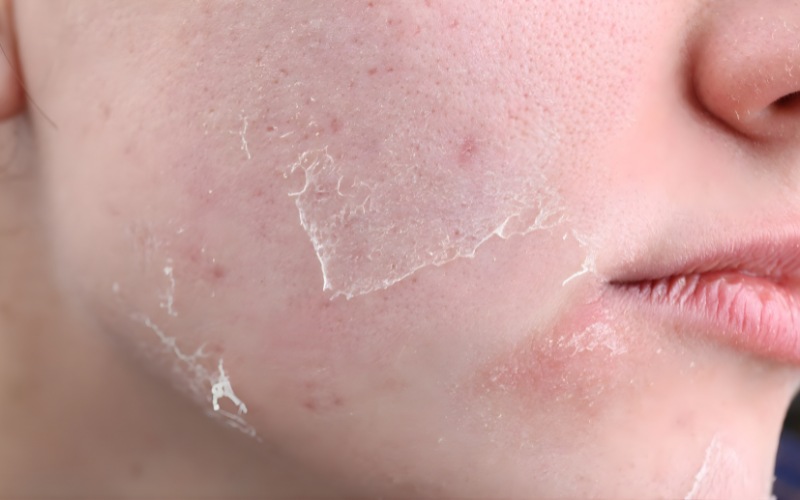 triệu chứng thiếu canxi ở người lớn